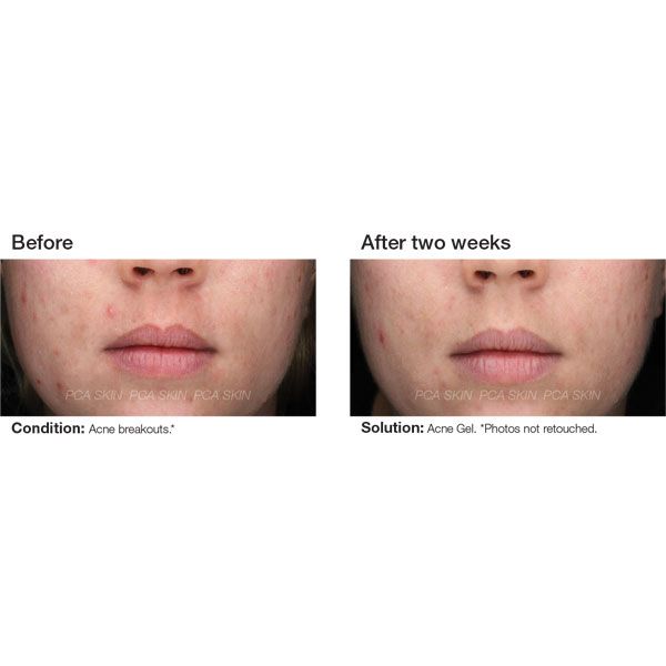 Acne Gel