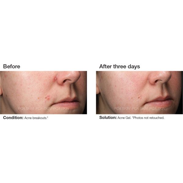 Acne Gel
